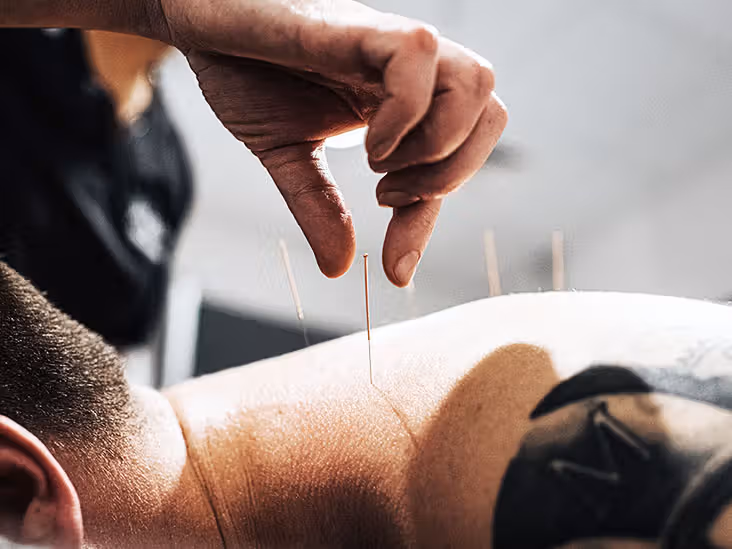 Is Acupuncture Safe? Understanding Risks and Side Effects